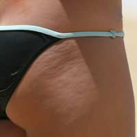 Cellulite & How To Get Rid Of It