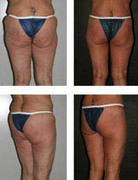 Buttock Implants Buttock Augmentation