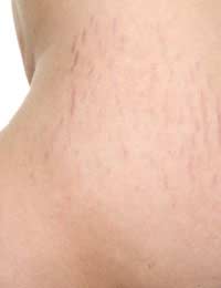 Stretch Marks Treating Stretch Marks