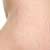 Preventing & Treating Stretch Marks